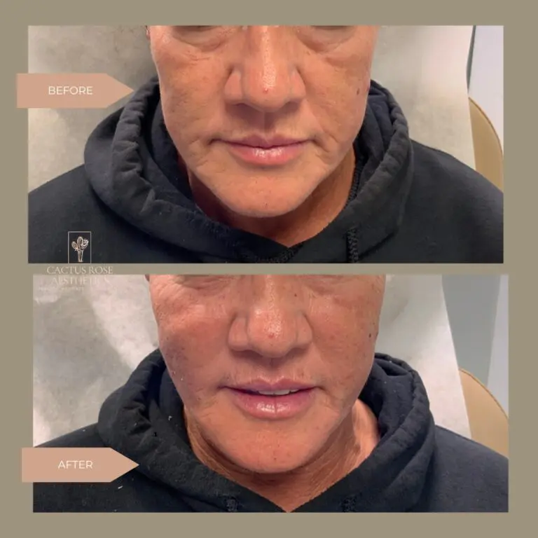 Radiesse Before & After